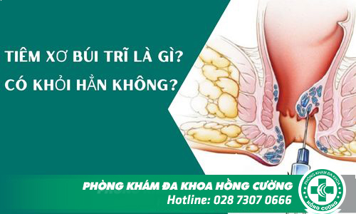 Tiêm xơ búi trĩ là gì? Có khỏi hẳn không?